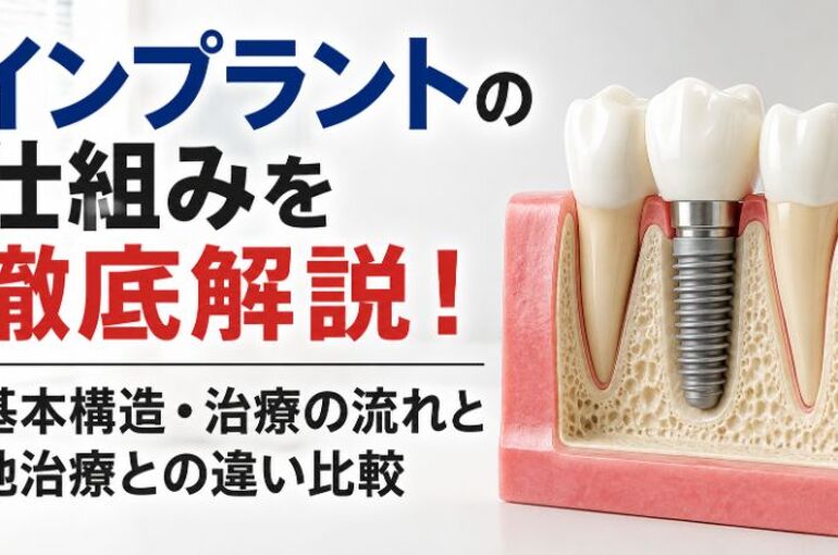 インプラント仕組み (2)
